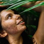 Hyperpigmentation: Excessive Pigmentation Of The Skin Hyperpigmentation Excessive Pigmentation Of The Skin